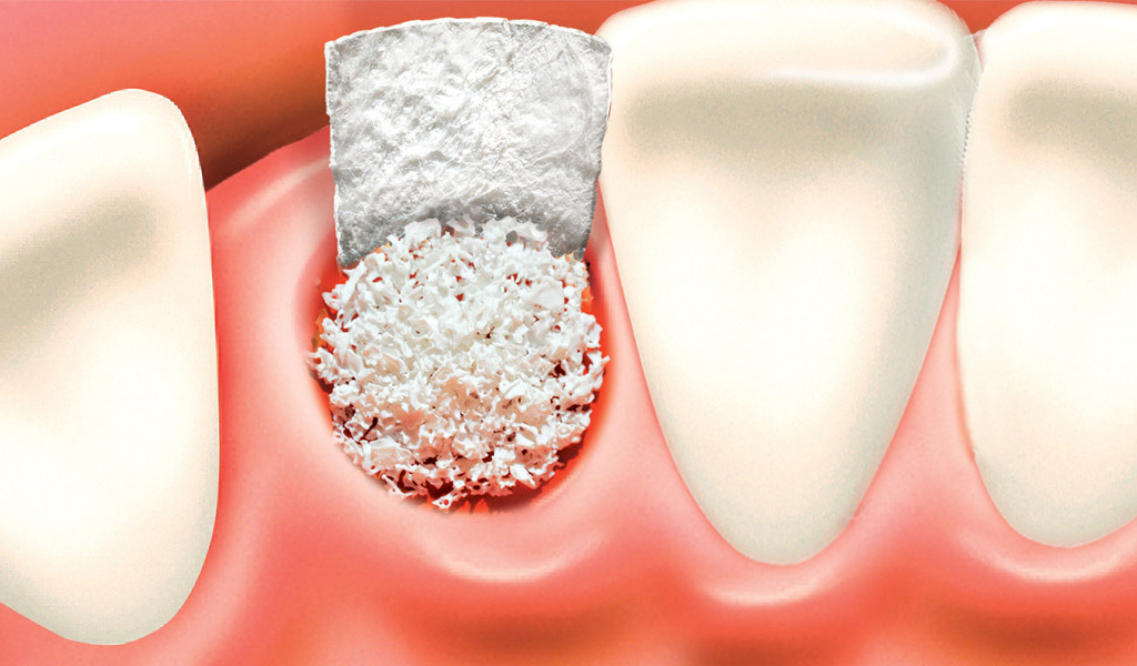 Implantes dentales en la Línea de la Concepción Implantes dentales en la Línea de la Concepción